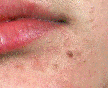 脸上的痘痘是粉刺还是扁平疣？一篇文章教你分辨和解决问题！